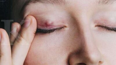 Gejala Muncul Benjolan Asing di Tubuh, Periksakan ke RSD Idaman